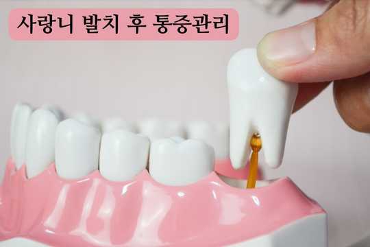 사랑니 발치 후 통증관리